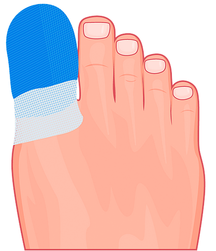 Nail Surgery | Stepping Out Podiatry